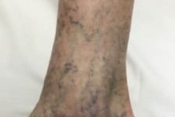 Placeholder Image for When to Worry About Spider Veins