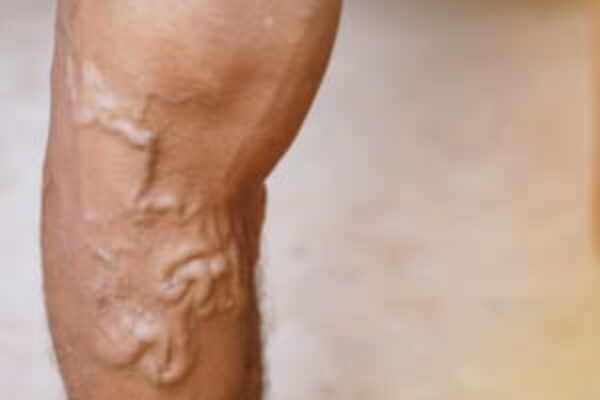 Placeholder Image for Are Varicose Veins Hereditary?