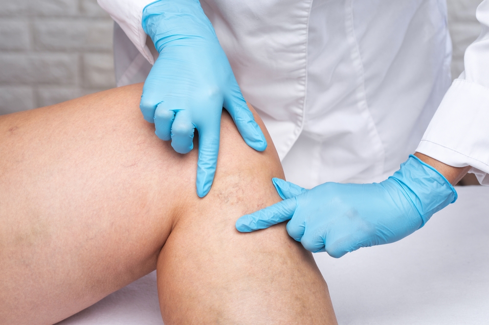 Close up of woman's legs as doctor examines spider veins in Portland, OR