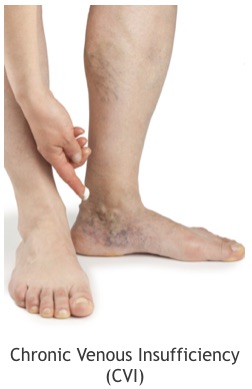 Chronic Venous Insufficiency