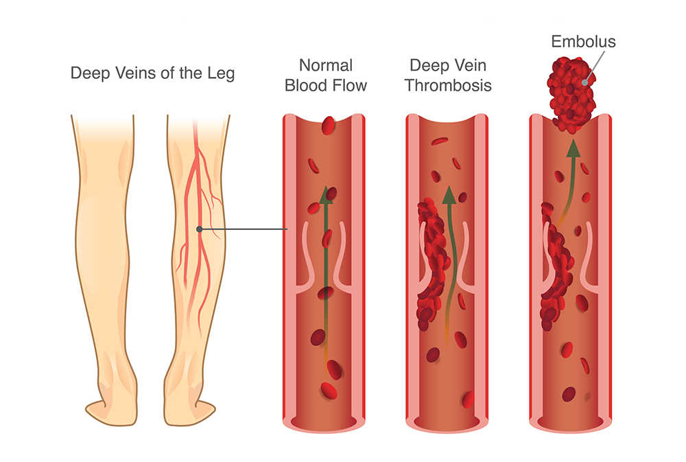 DVT diagnosis