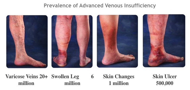 Prevalence Advanced Venous Insufficiency