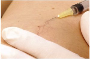 Sclerotherapy