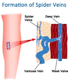Spider Veins