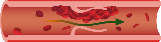 dvt clot illustation