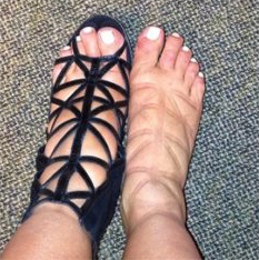 leg swelling