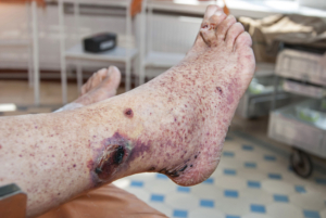 Hemorrhagic vasculitis. Diabetic foot syndrome