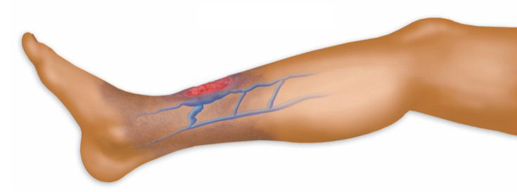 venous stasis ulcer 1