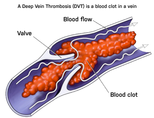 dvt blood clot
