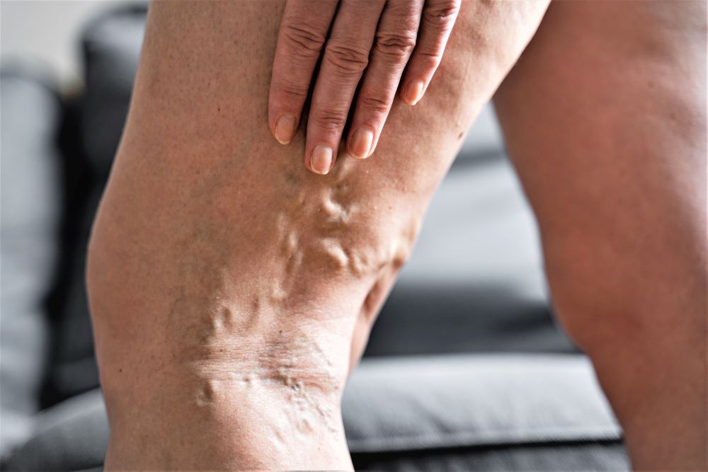 varicose veins leg