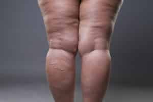 Back view of swollen lower legs with visible varicose veins and areas of skin redness.