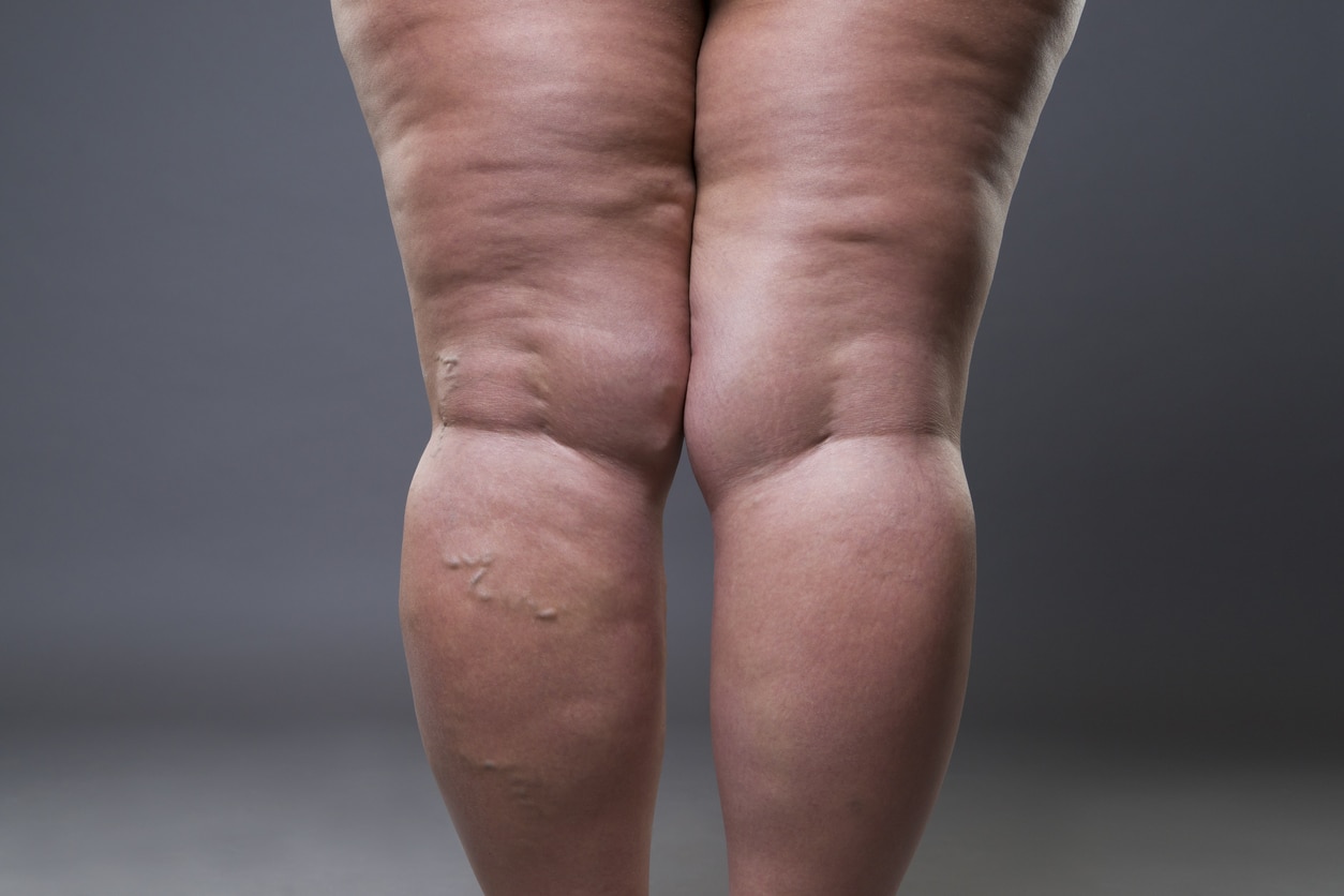 Back view of swollen lower legs with visible varicose veins and areas of skin redness.