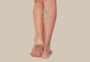 Back view of swollen lower legs with visible varicose veins and areas of skin redness.