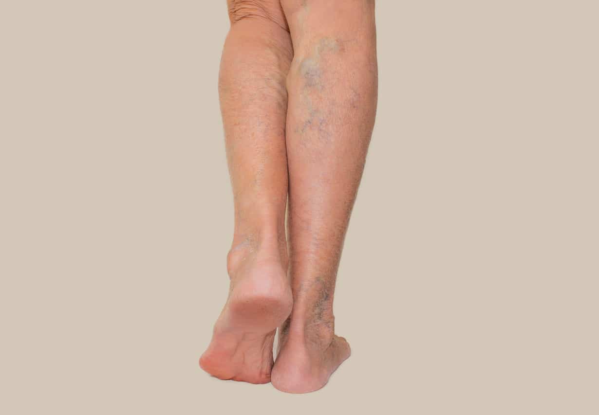 Back view of swollen lower legs with visible varicose veins and areas of skin redness.