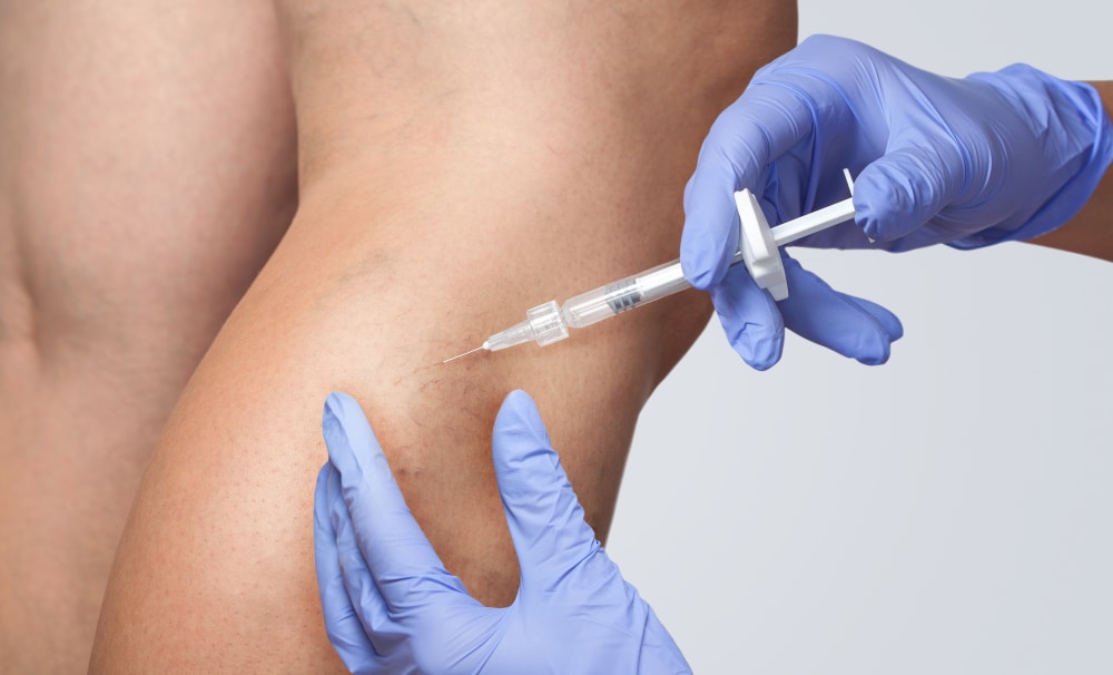 Woman's legs as she gets treatment injections for spider veins