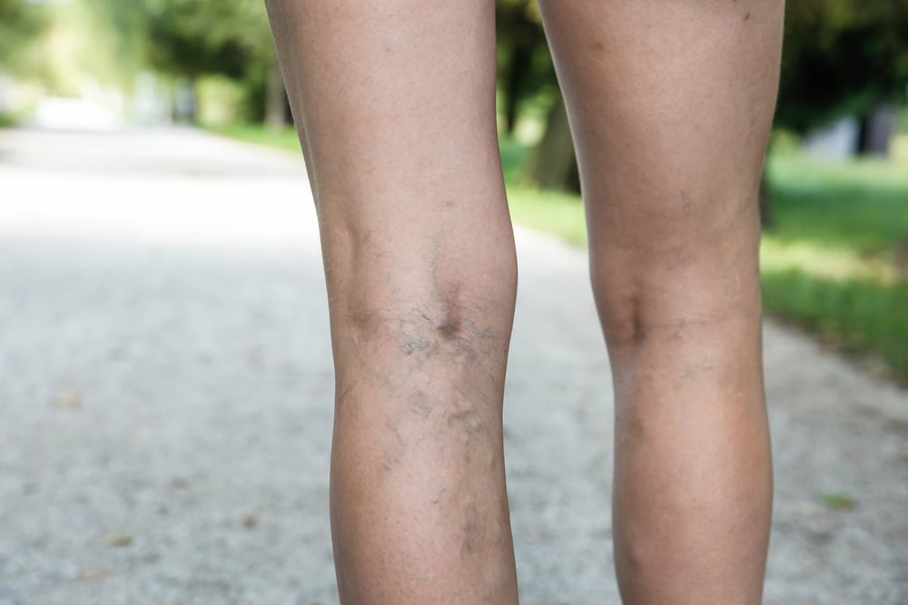 Person walking with varicose veins in Portland, OR